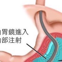 胃内肉毒桿菌注射/水球置放減重經驗分享
