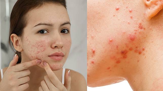 情報快遞 擠痘痘鬧出人命 醫 只有這類痘才可擠 Sponsored Line Today