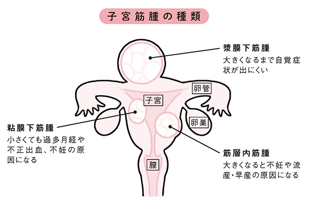 筋腫の重さが5kgになることも 女性婦人科医が教える 子宮筋腫 の種類と治療法