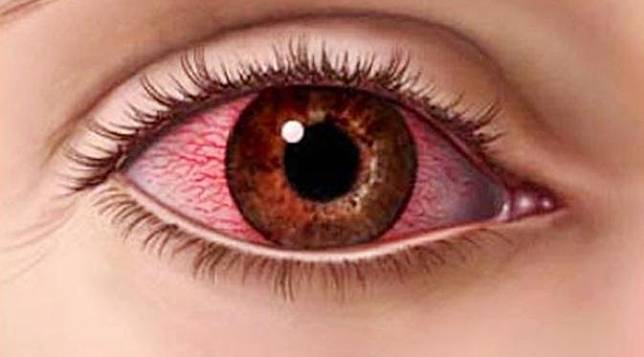 6 Kondisi Mata Ini Bisa Ungkapkan Kondisi Tubuh