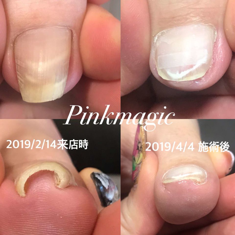 巻き爪補正 ネイルサロンピンクマジック Line Official Account