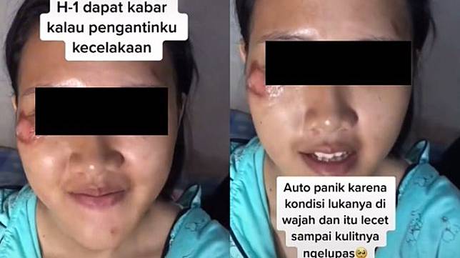 Wajah Pengantin Luka karena Kecelakaan, Hasil Riasan MUA Ini Sukses Sembunyikan Luka (TikTok)