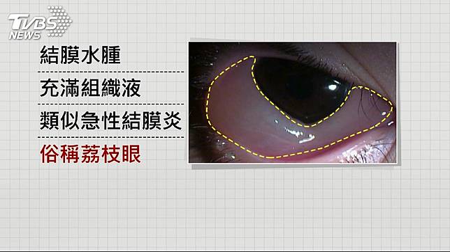 黑眼球不見 揉眼睛結膜腫成 荔枝眼 Tvbs Line Today