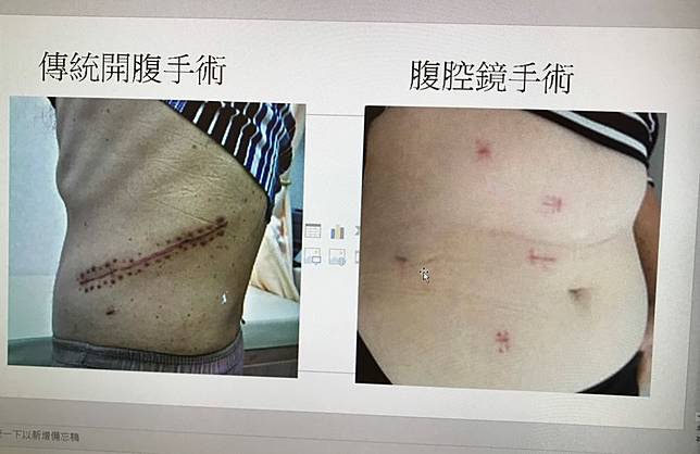 大新竹首例 腹腔鏡部分腎臟切除85歲病患順利出院 Nownews 今日新聞 Line Today