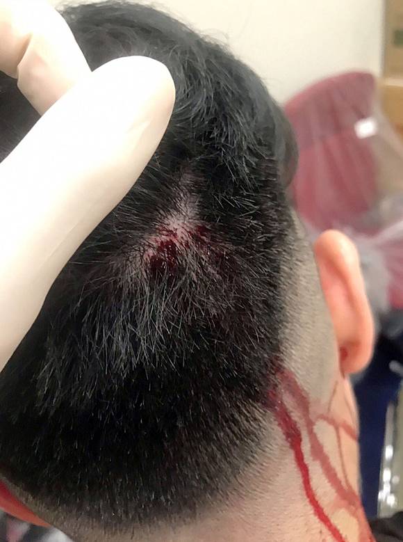 Woman Says She Needed Stitches On Her Head After Hong Kong Police