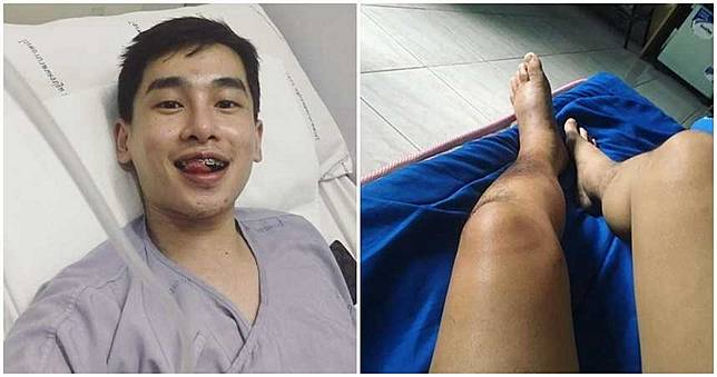 24歲男星皮膚癌病逝！　生前樂觀發文：我失去了腳...粉絲淚崩
