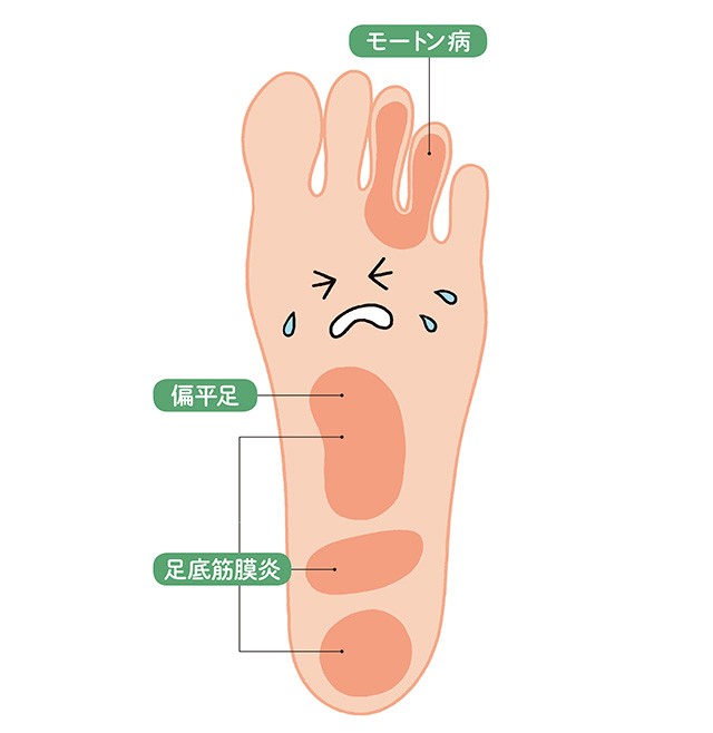 足底筋膜炎 モートン病を改善 足裏の痛みを治す 10秒つま先立ち まとめ