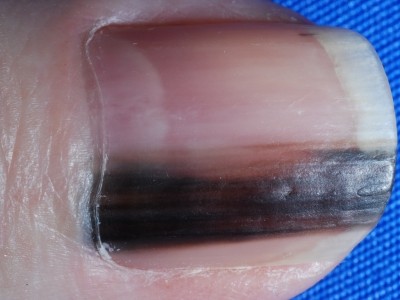 これって がん 爪が黒くなる病気と治療法