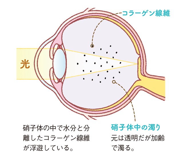 ずっと 糸くず が浮いて見える 目の病気 飛蚊症 基礎知識