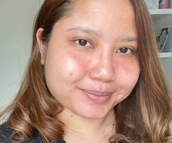 4 Langkah Untuk Mengatasi Kulit Iritasi Female Daily Line Today