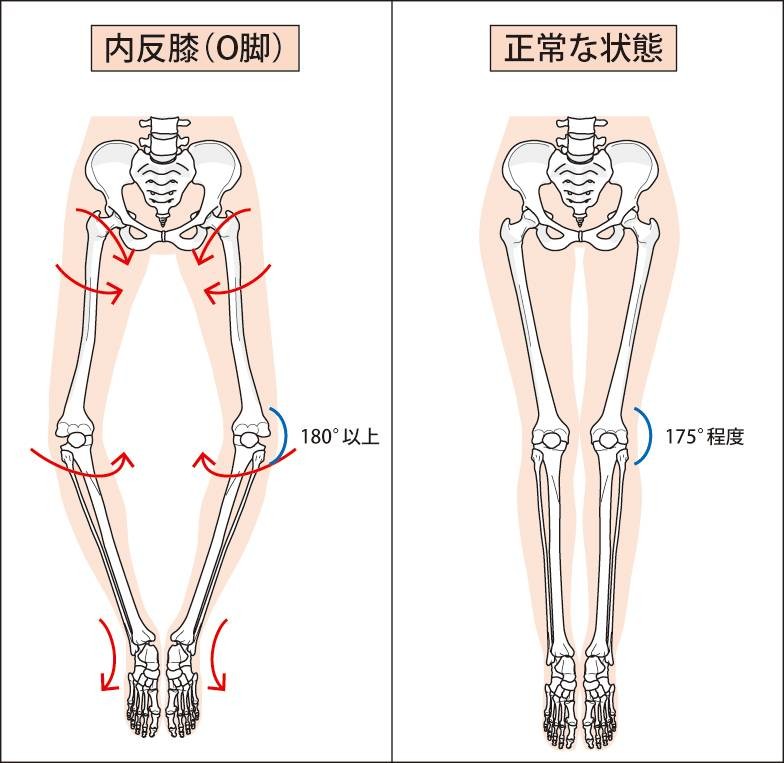 全部当てはまったら要注意 女性に多い 内股o脚 内股o脚さんの共通点3つと改善ポーズ