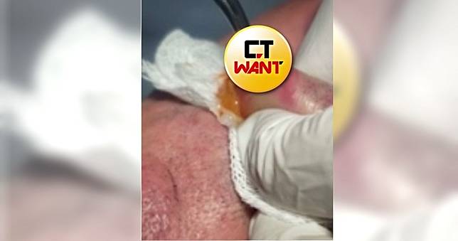 噁心！男唇上小洞驚見「蠕動生物」　醫用力夾出「白嫩肥蟲」