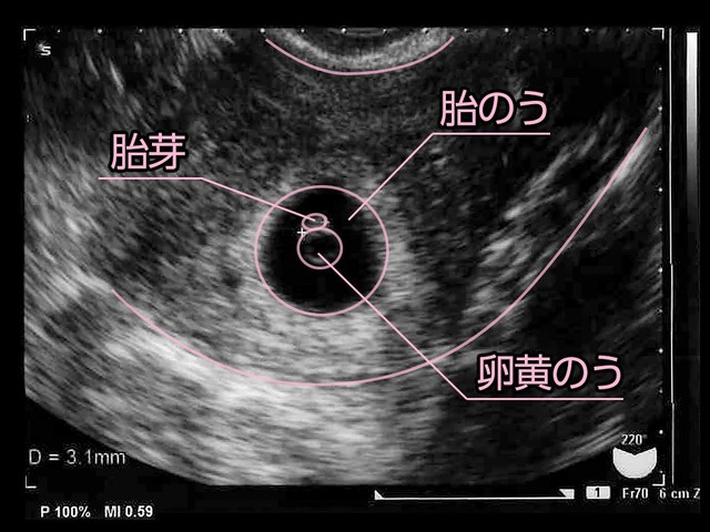 妊娠6週目 胎芽や胎嚢大きさ 心拍の確認も All About