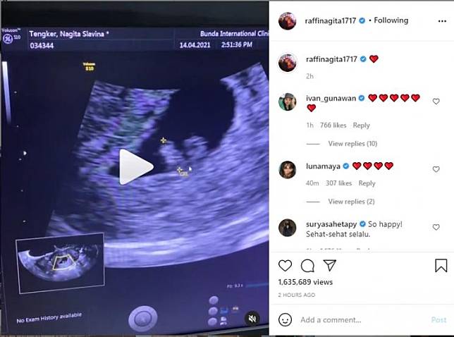 Raffi Ahmad dan Nagita Slavina memperlihatkan potret USG calon bayinya. (Instagram/raffinagita1717)