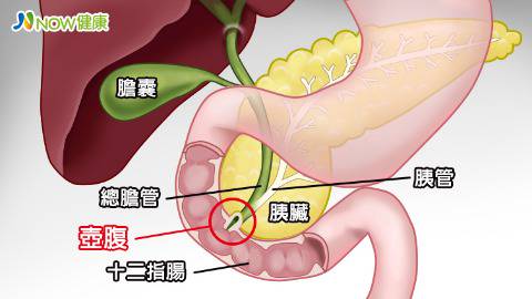 罕見壺腹癌難確診家族性腺性息肉患者屬高危險群 Now健康 Line Today