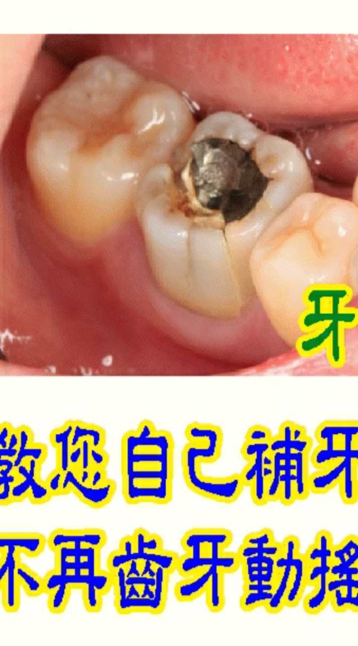 牙齒醫護拒絕拔牙在家自己補牙自己固定鬆動的牙齒