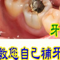 牙齒醫護拒絕拔牙在家自己補牙自己固定鬆動的牙齒