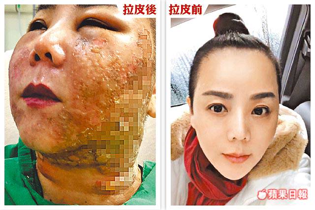 ã€Œé›»æ³¢æ‹‰çš®ã€çš„åœ–ç‰‡æœå°‹çµæžœ