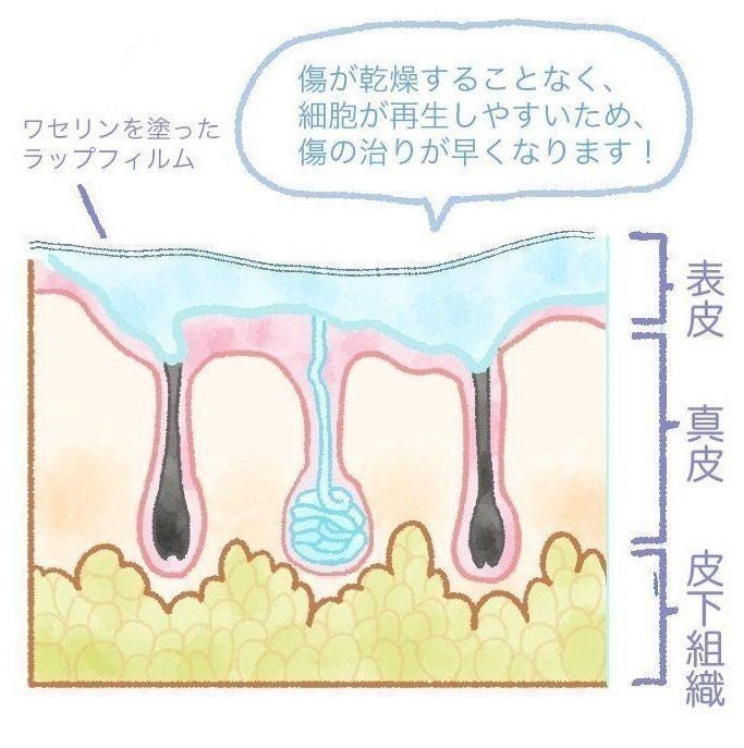 出産時の医療処置 会陰切開 お産のとき切るって本当