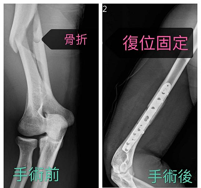 手居然斷了 肌肉猛男比腕力下場悽慘醫師 關鍵在於扭力 Ctwant Line Today