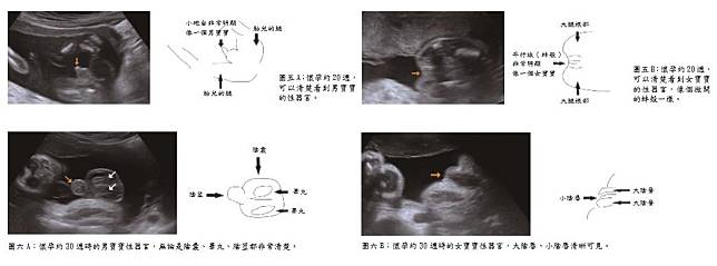 超音波看胎兒性別的真相 Kingnet 國家網路醫藥 Line Today