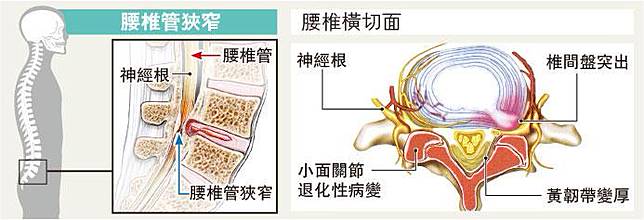 腰椎管收窄行一陣腳痛壓住神經嚴重致失禁 明報 Line Today
