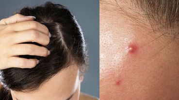 明明有洗髮，但頭皮老是長痘痘、粉刺為什麼？愛吃「乳製品」也是原因之一！