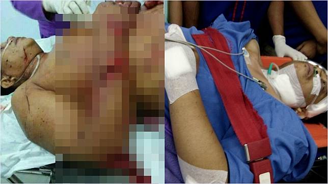 Kondisi Hermansyah Usai Jalani Operasi di RS Hermina Depok