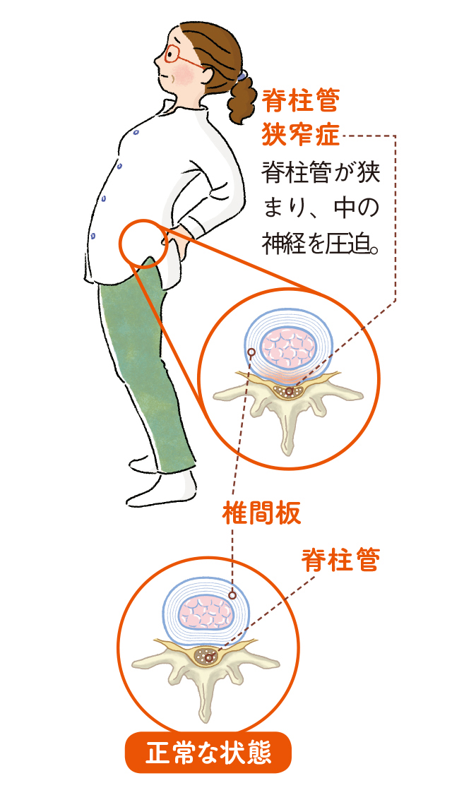 過敏性腸症候群 Ibs の症状と対策 セレキノンs Ibsの再発症状改善薬 田辺三菱製薬