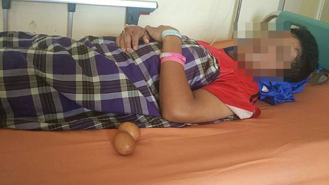 Total sudah 20 butir telur yang dikeluarkan dari dalam tubuh Akmal, remaja asal Gowa, dihitung dari kejadian pertama pada 2015. (Liputan6.com/Fauzan)