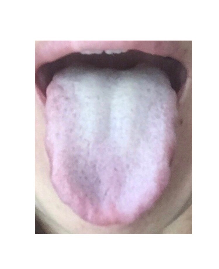 いつのまにか「うつ」。舌を見て今の自分に氣づいてね
