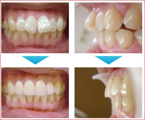 症例写真 ザ ホワイトデンタルクリニック