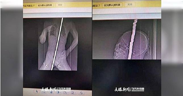 男童墜樓遭鋼筋刺穿　「心臟收縮」逃過死神魔掌