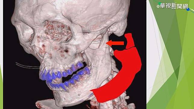 半罩安全帽不安全出車禍易下顎骨折 華視新聞 Line Today