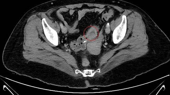 影像檢查發現秦媽媽直腸處的惡性腫瘤。圖／台北慈濟醫院提供