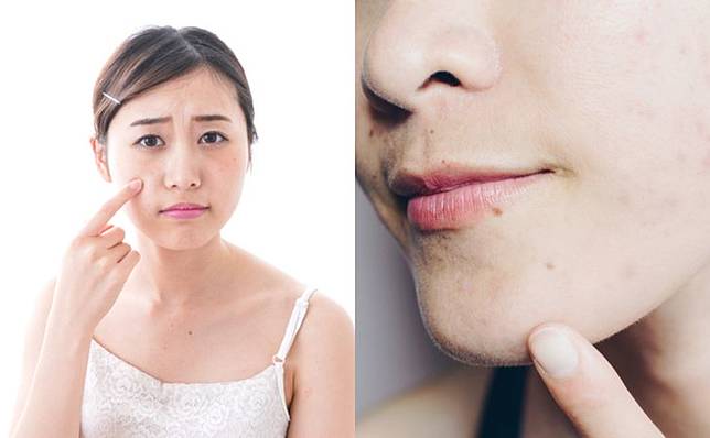 眼周油脂粒只因為護膚品太潤 中醫可能是脂溢性皮炎 Cosmopolitan Hk Line Today