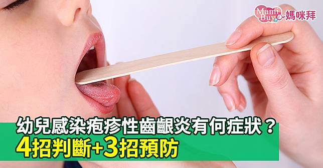 幼兒感染疱疹性齒齦炎有何症狀 4招判斷 3招預防 Mamibuy媽咪拜 Line Today