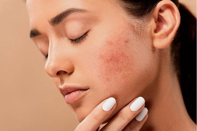 Siap Grak 5 Tips Memilih Sunscreen Yang Tepat Sesuai Jenis Kulit