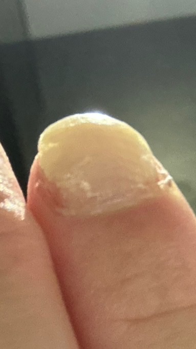 @mail｜指甲黴菌感染治療過程
