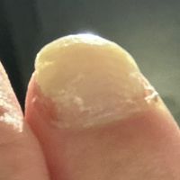 @mail｜指甲黴菌感染治療過程