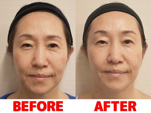 体験談 プチ整形でシワはどのぐらい消えた