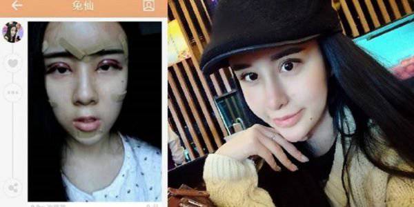 Masih Berusia 15 Tahun, Gadis Ini Pilih Jalani Operasi Plastik Ekstrim