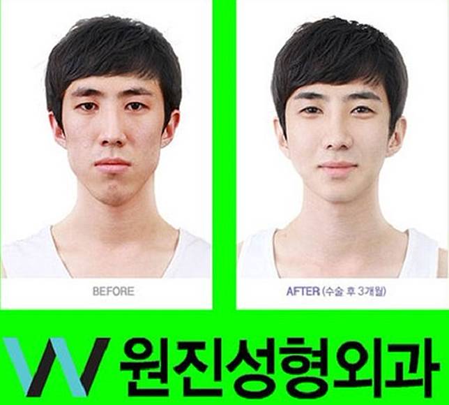 15 Foto Sebelum dan Sesudah Cowok Korea Oplas, Nyaris Mirip Oppa Boyband!