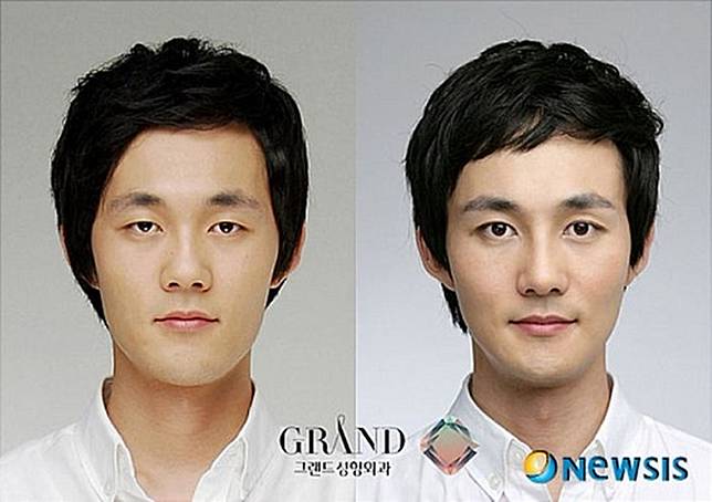 15 Foto Sebelum dan Sesudah Cowok Korea Oplas, Nyaris Mirip Oppa Boyband!