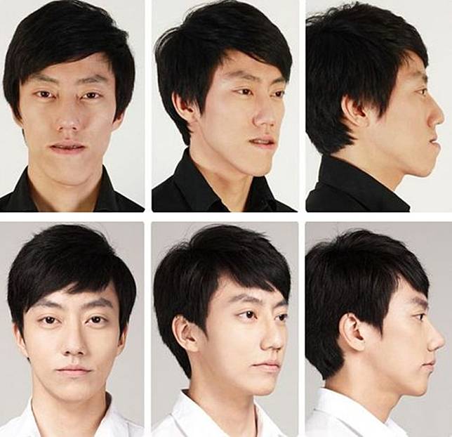 15 Foto Sebelum dan Sesudah Cowok Korea Oplas, Nyaris Mirip Oppa Boyband!
