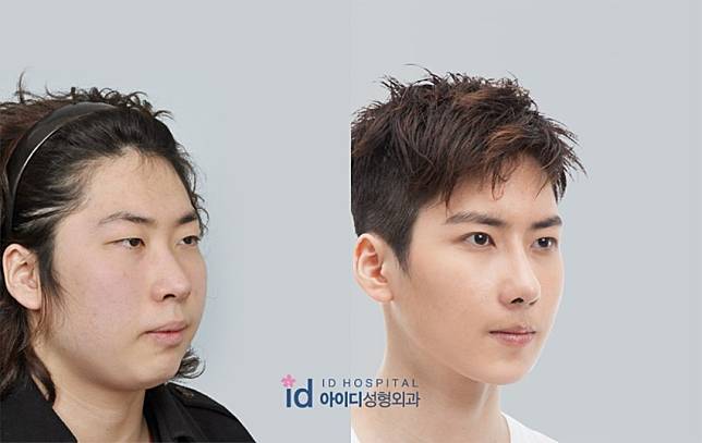 15 Foto Sebelum dan Sesudah Cowok Korea Oplas, Nyaris Mirip Oppa Boyband!