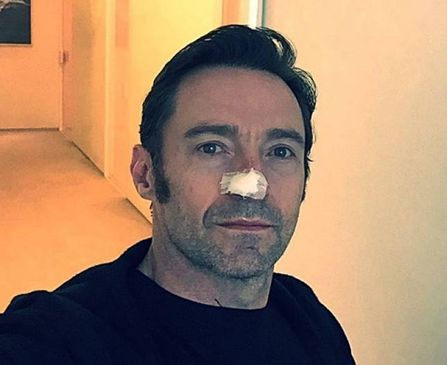 Kembali Didiagnosis Kanker Kulit, Hugh Jackman Ingatkan Pentingnya Tabir Surya