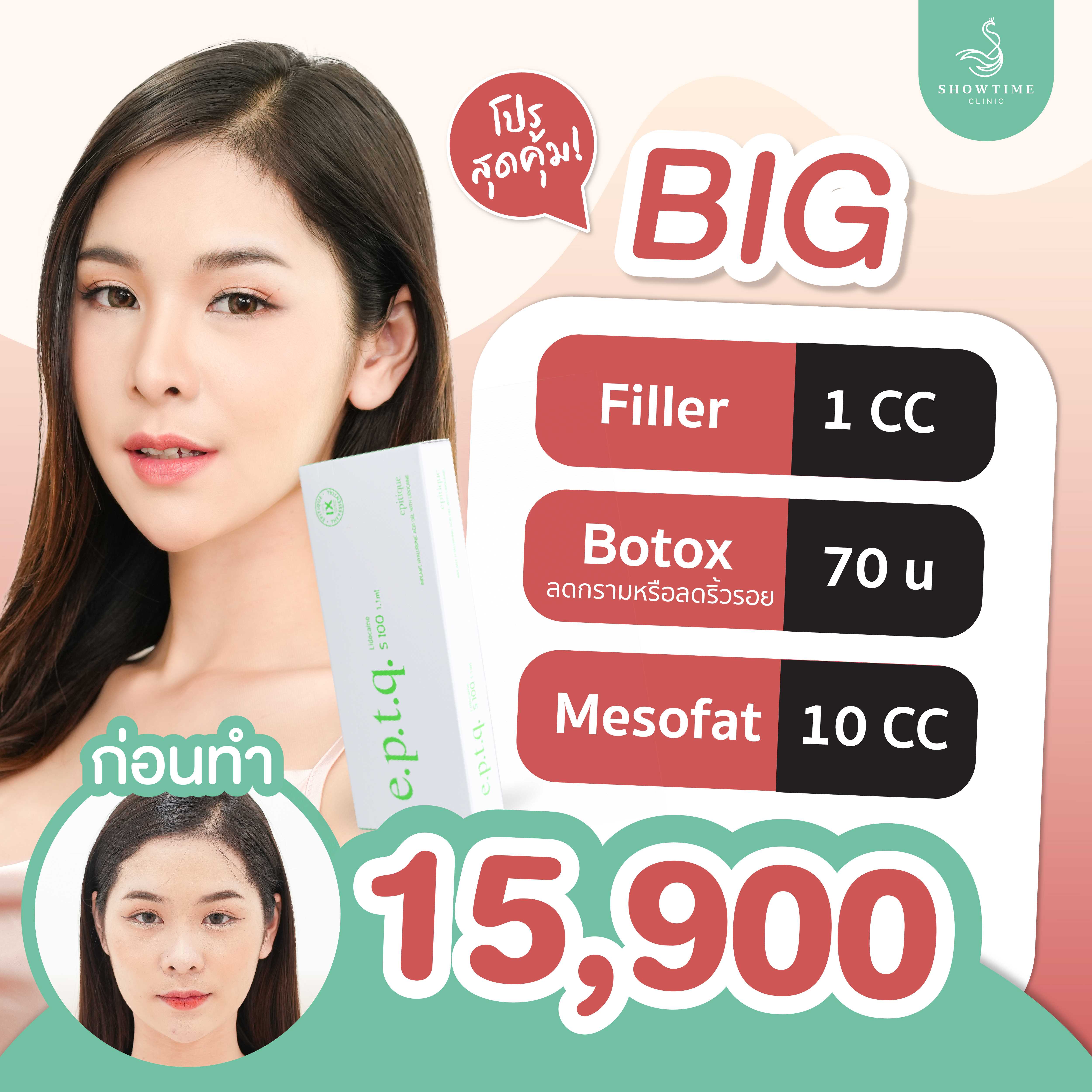 Big !!! โปรใหญ่ลดจัดเต็ม Fliler Botox Mesofat